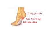 Viêm Cân Gan Chân Chạy Bộ : Cách Phòng và Điều Trị Hiệu Quả